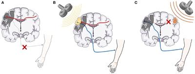 Predicting Individual Treatment Response to rTMS for Motor Recovery After Stroke: A Review and the CanStim Perspective